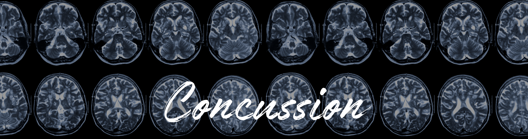 Concussions